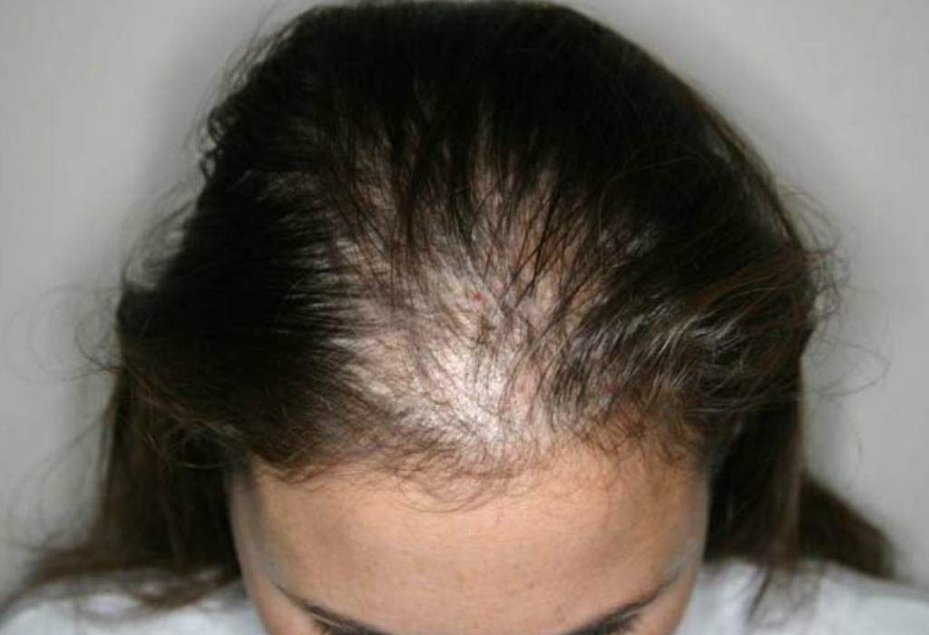 Diffuse Hair Loss